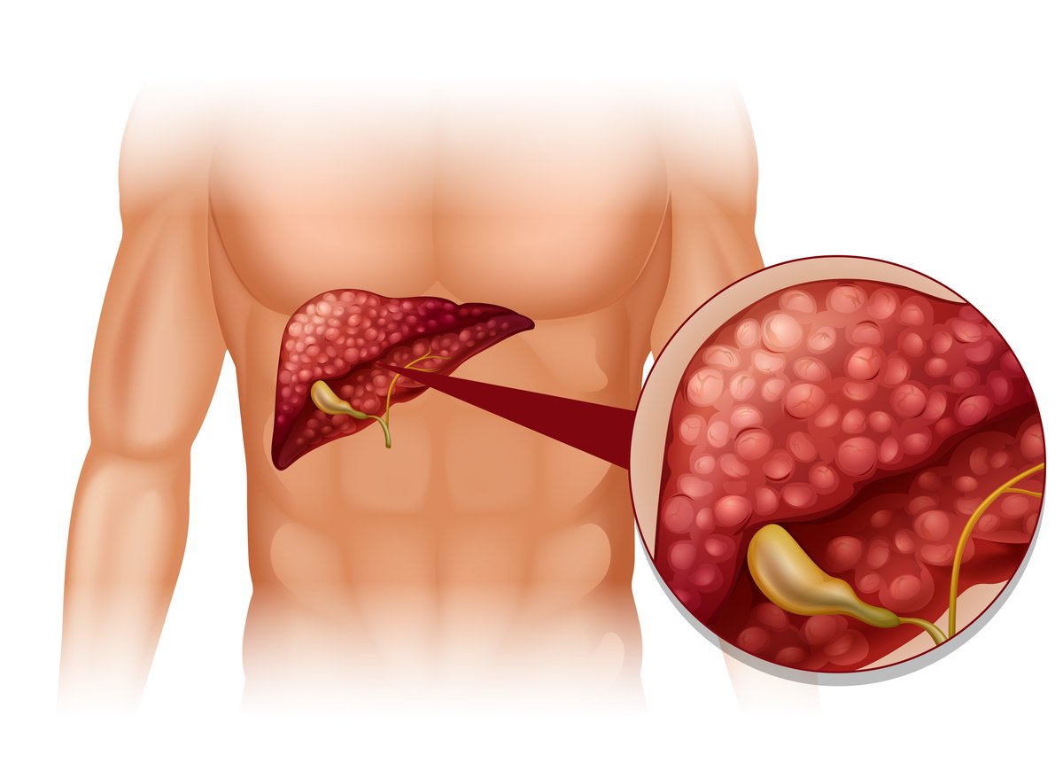 Medical illustration of a fatty liver (NAFLD)